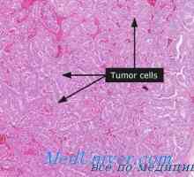 Clasmocytoma in limfom ščitnice. Fluorescentna mikroskopija ščitnice
