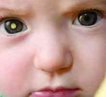 Retinoblastom pri otrocih: simptomi, zdravljenje, vzroki, simptomi