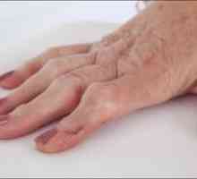Revmatoidni artritis prstov: simptomi, zdravljenje, vzroki, simptomi