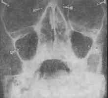 Rhinogenous zapleti. Različne oblike rinitisa