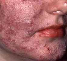 Koža rozacee: zdravljenje, simptomi, vzroki, simptomi