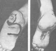 Brazgotina deformacija stopala in gležnja. napake Zdravljenje plantarna površina stopala glede na…