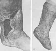 Brazgotina deformacija stopala in gležnja. Brazgotine na področju gležnja