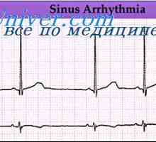 Srčne aritmije. Kršitev ritmu sinusnega vozla