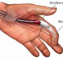 Trigger finger: vzroki, zdravljenje, simptomi, znaki, preventiva