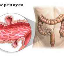 Simptomi in zdravljenje diverticulosis na sigmoidno debelega črevesa