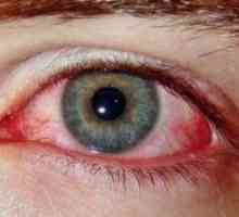 Sindrom rdeče oči: Zdravljenje