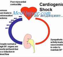 Kardiogeni šok. Fiziologija zdravljenje kardiogeni šok