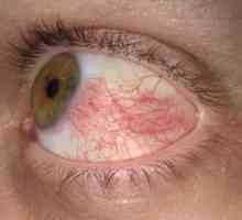 Skleritis oči: zdravljenje, simptomi, vzroki, simptomi