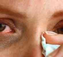 Solzenje oči: zdravljenje, vzroki, simptomi, znaki