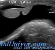 Spermatocele in hydrocele pri otrocih. testisov tumorjev