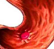 Gastritis faza novinec, poslabšanje, remisijo in teče ven poslabšanjem