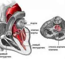 Aortno stenozo, usta, zdravljenje, vzroki, simptomi, znaki