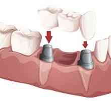 Dentalni naprave: mostovi, odstranljive delne in cele zobne proteze