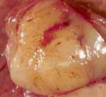 Želodca gastrointestinalni stromalni tumor (GIST zgod)