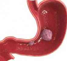 Stromalni tumorji gastrointestinalnega trakta: simptomi, zdravljenje, simptomi