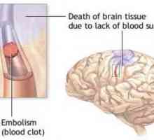 Subarahnoidna krvavitev, posledice, zdravljenje, simptomi