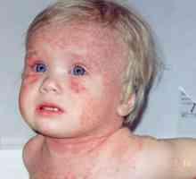 Izpuščaj pri otroku na dysbacteriosis