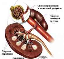 Končne ledvične bolezni (kronična odpoved ledvic), diabetesa