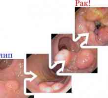 Vrste polipov na želodcu