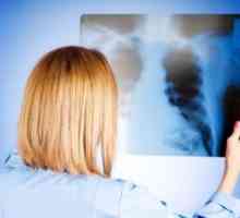 Akutni respiratorni sindrom
