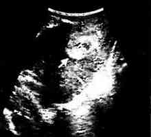Transvaginalnih ultrazvok diagnoza poporodne endometritisa