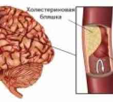 Tranzitorna ishemična ataka: simptomi, zdravljenje, posledice
