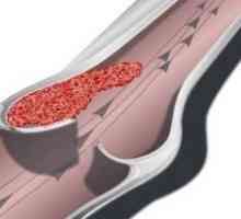 Tromboza krvi: oblike, kakšna je klasifikacija