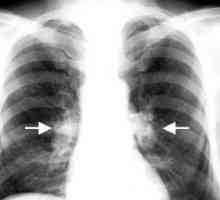 Tuberkuloza intratorakalnih bezgavk: zdravljenje, zapleti, vzroki, simptomi