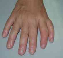 Podvojitev prvi prst (ali pramena preaxial Polydactyly)