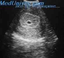 Ultrazvok je v prvem trimesečju nosečnosti. Indikacije za transvaginalno ultrazvoka v prvem…