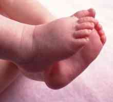 VARUS deformacija proksimalne stegnenice pri otrocih