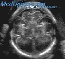Pred rojstvom oskrba z ventriculomegaly. prirojene hidrocefalus