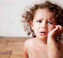 Virusne bolezni pri otrocih, ki jih spremlja izpuščaj