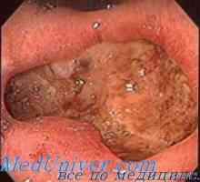 Vpliv endokrinih žlez v želodcu trofiku