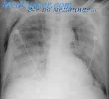 Vpliv intravaskularno zrak v pljuča. Vpliv rekompresijsko na pljučih