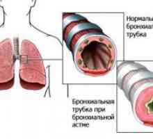 Prirojene malformacije bronhijev