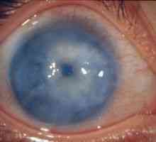 Sekundarni glavkom oči: zdravljenje, vzroki, klasifikacija, simptomi, znaki