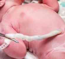 Prolaps popkovnice ob rojstvu: učinki, so vzroki