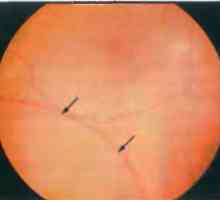 Bolezni obodu mrežnice: degenerativne retinoschisis