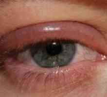 Bolezni stoletja človeškega očesa: zdravljenje, preprečevanje, znaki, simptomi, vzroki