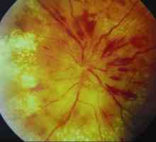 Kongestivno optični disk s sindromom hipertenzije-hydrocephalic
