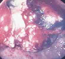 Žlezni rak želodca