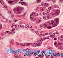 Maligni insuloma. Morfologija tumorjev Langerhansovih otočkov