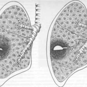 Pljučni absces: simptomi, zdravljenje, diagnoza, zapletov, vzroki, simptomi