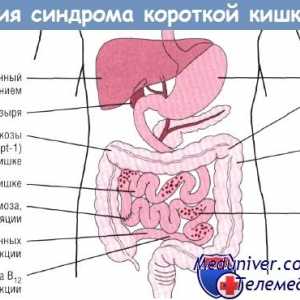 Prilagoditev organizma sindrom kratkega črevesa (CCM)