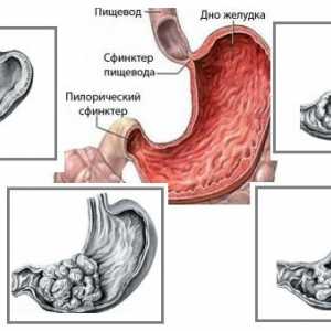 Adenokarcinom (rak), želodcu