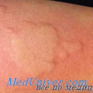 Adrenostimulyatorov alergije. Antiholinergiki z alergijskimi reakcijami