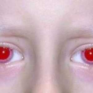 Albinizem pri ljudeh: simptomi, vzroki, simptomi, zdravljenje