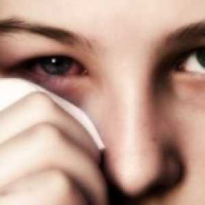 Alergijski konjunktivitis: zdravljenje, simptomi, vzroki, simptomi